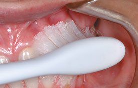 Excessive brushing can cause gum recession.