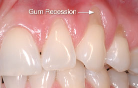 Gum recession caused by brushing teeth too hard.