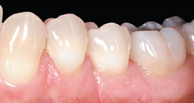 Repair of gum recession.