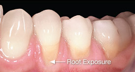 Severe gum recession.