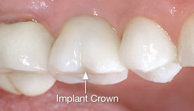 Dental implant crown.