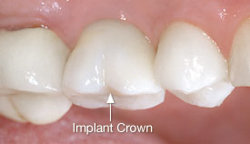 Dental implant crown.