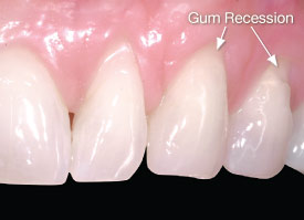 Bone loss and gum recession showing root exposure.