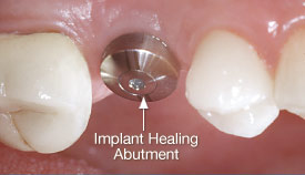 Healing abutment attached to an implant.