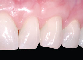 Periodontal plastic surgery.