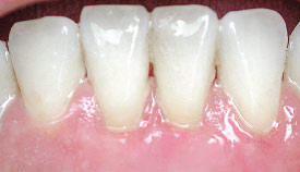 Removal of tartar and periodontal plastic surgery.