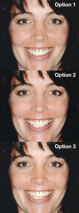 Gummy smile correction options.