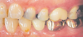 Low periodontal risk.