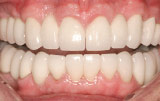 Dental implants after.