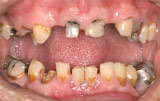 Dental implants before.