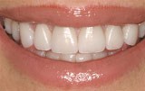 Dental veneers after.