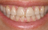 Dental veneers before.