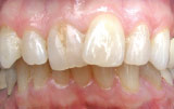 Orthodontics before.