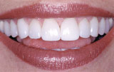 Periodontal plastic surgery after.
