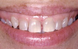 Periodontal plastic surgery before.