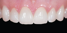 After porcelain veneers.