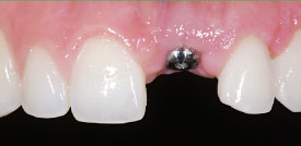 Dental implant abutment.