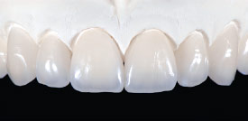 Dental laboratory porcelain veneers.