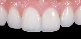 Porcelain veneers after.