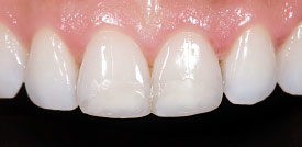 Porcelain veneers before.