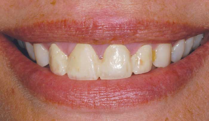 Before porcelain veneers.