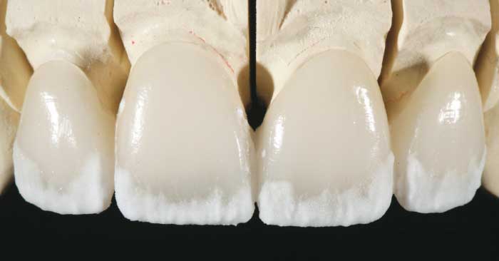 Lab technician creating porcelain veneers.