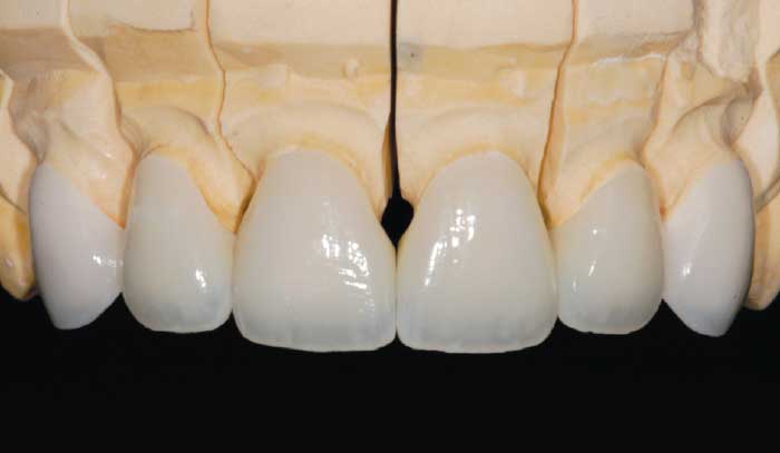 Porcelain veneer model.