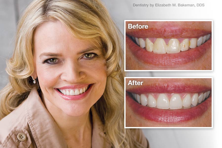 Porcelain Veneers - Before and After.