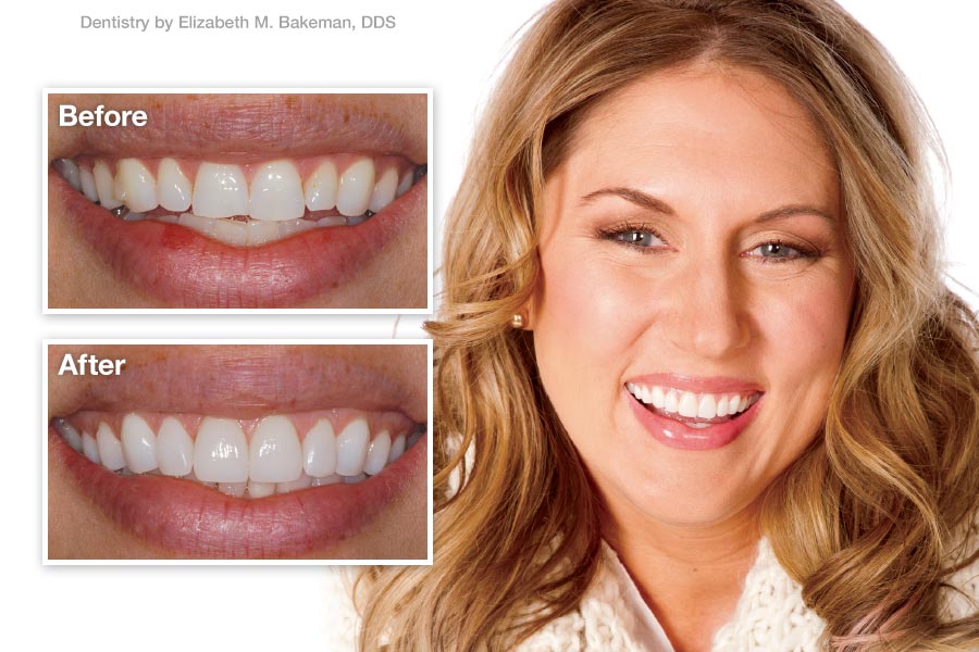 Porcelain Veneers - Patient Before and After.