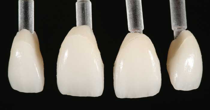 Thin porcelain veneers.