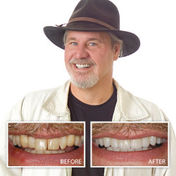 Before and After Porcelain Veneers