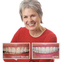 Before and After Porcelain Veneers