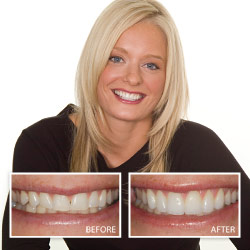 Before and After Porcelain Veneers