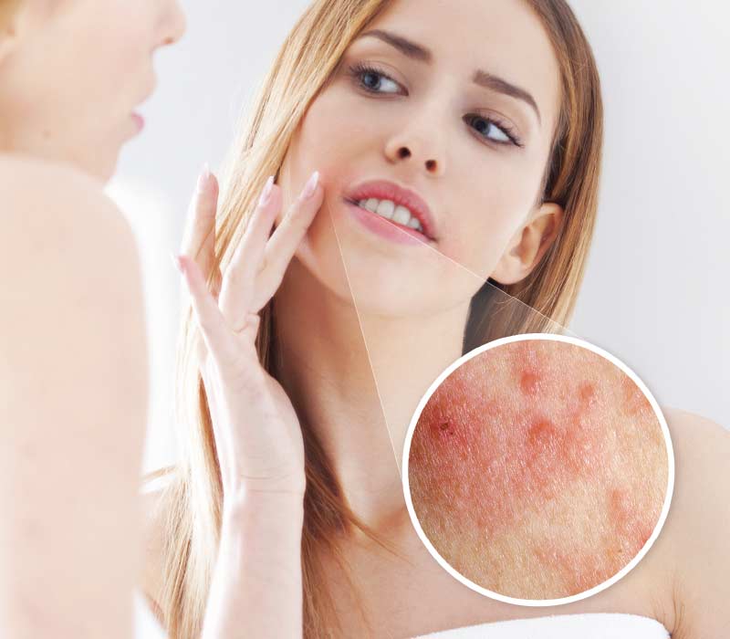 Peri-oral Dermatitis - Rash around the mouth.