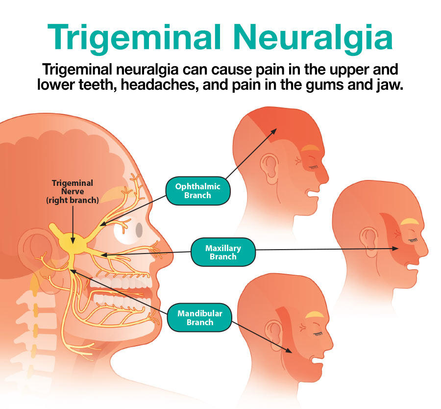 Referred Pain