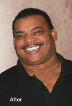 Refrigerator perry smile after treatment