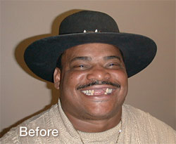 Refrigerator perry smile before treatment