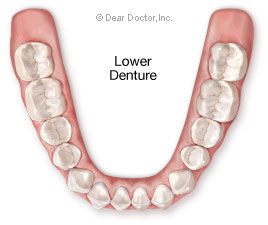 Lower denture.