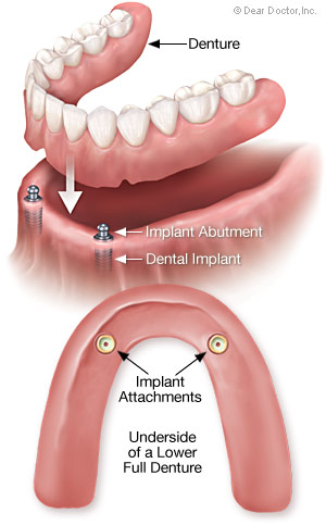 Removable full denture.