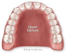 Upper denture.