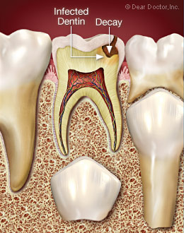 Infected dentin.