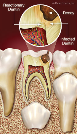 Reactionary dentin.