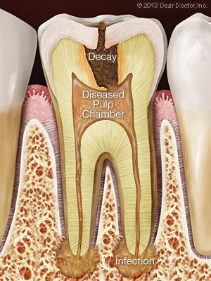 Infection from tooth decay.