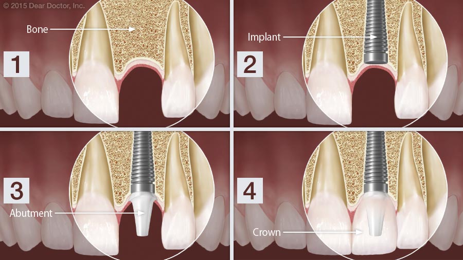 Dental implants step by step.