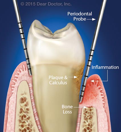 Gum disease and bone loss.