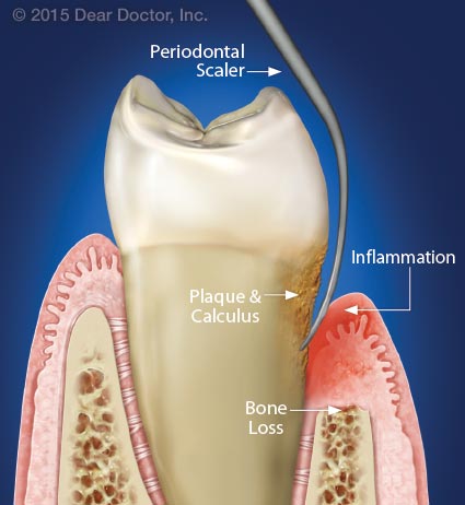 Periodontal scaler removing plaque.