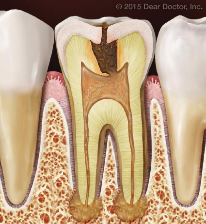 Tooth decay causing infection.