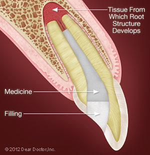 Deeper Pulpotomy.