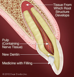 Indirect Pulp Cap Technique.