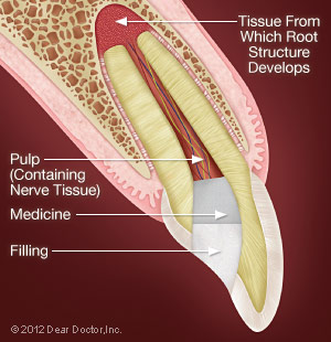 Pulpotomy.